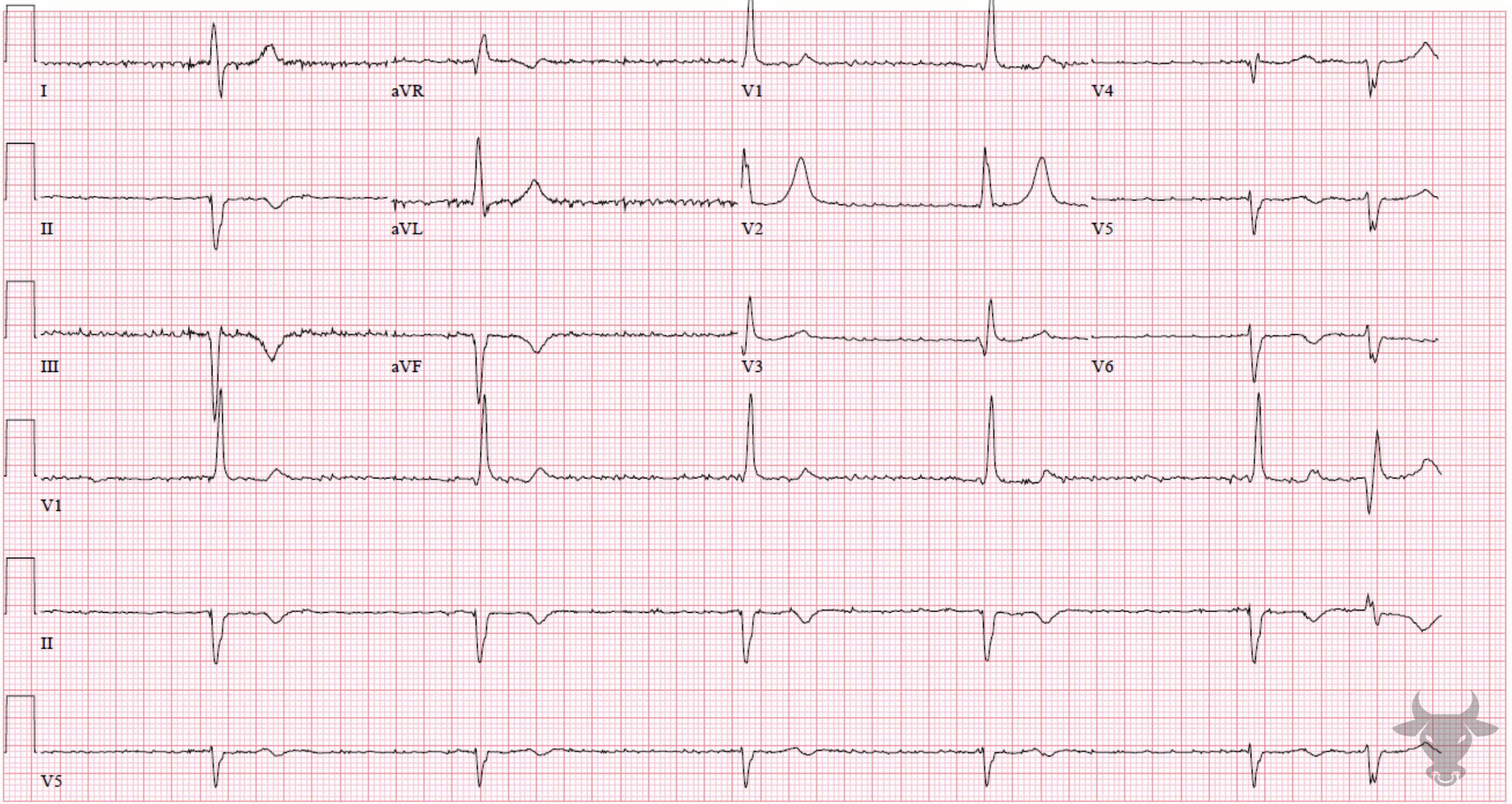 ECG Showing Third Degree Atrioventricular Block