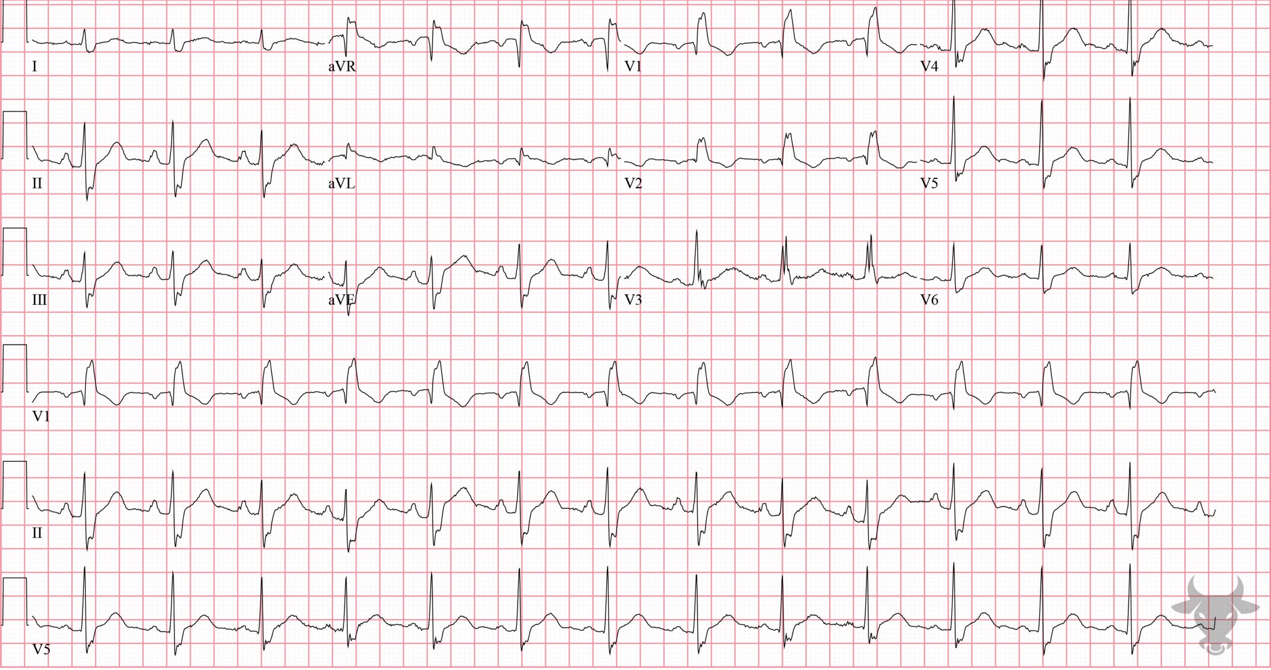 ECG Showing Right Bundle Branch Block