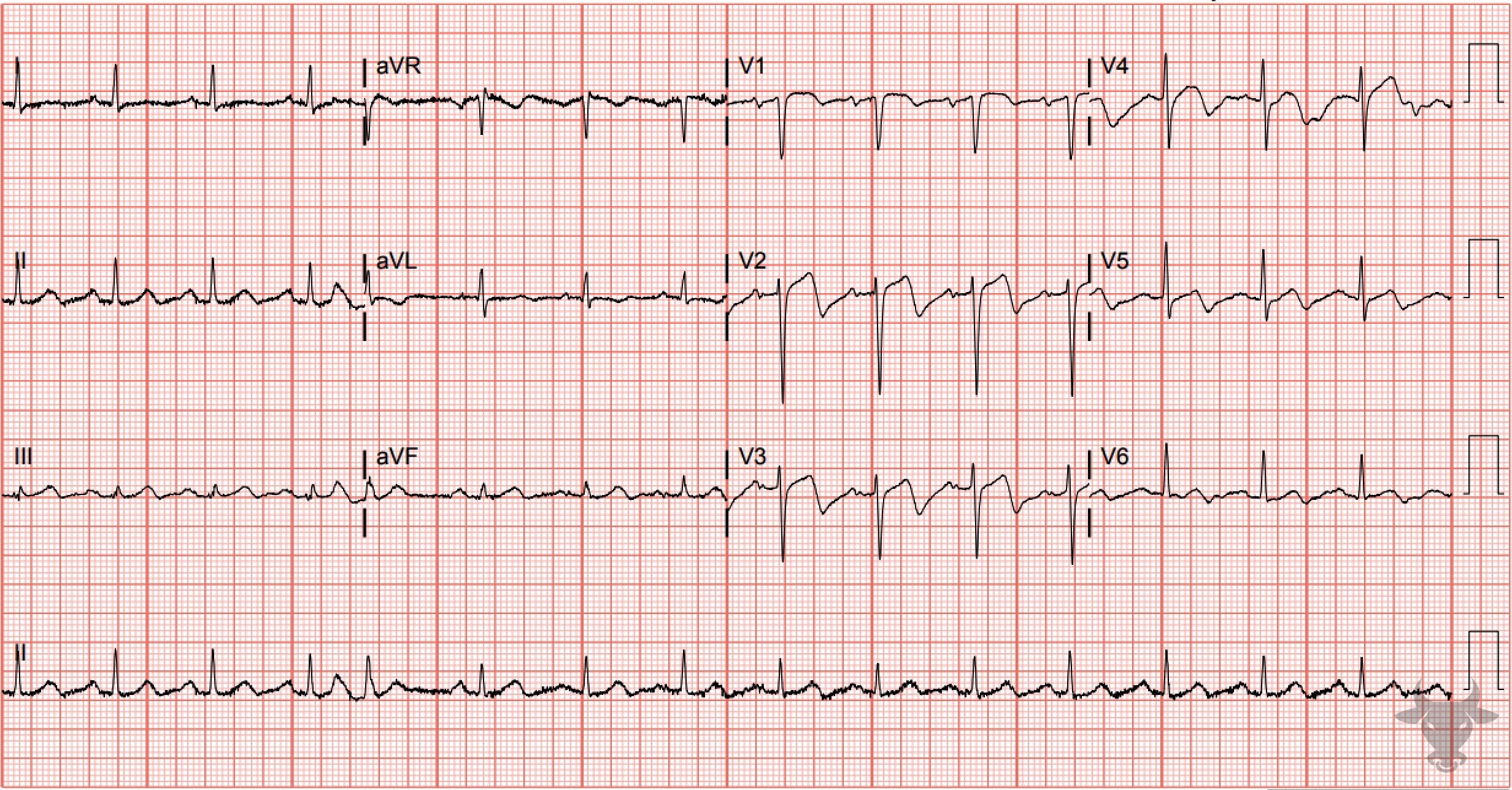ECG Showing Wellens Syndrome
