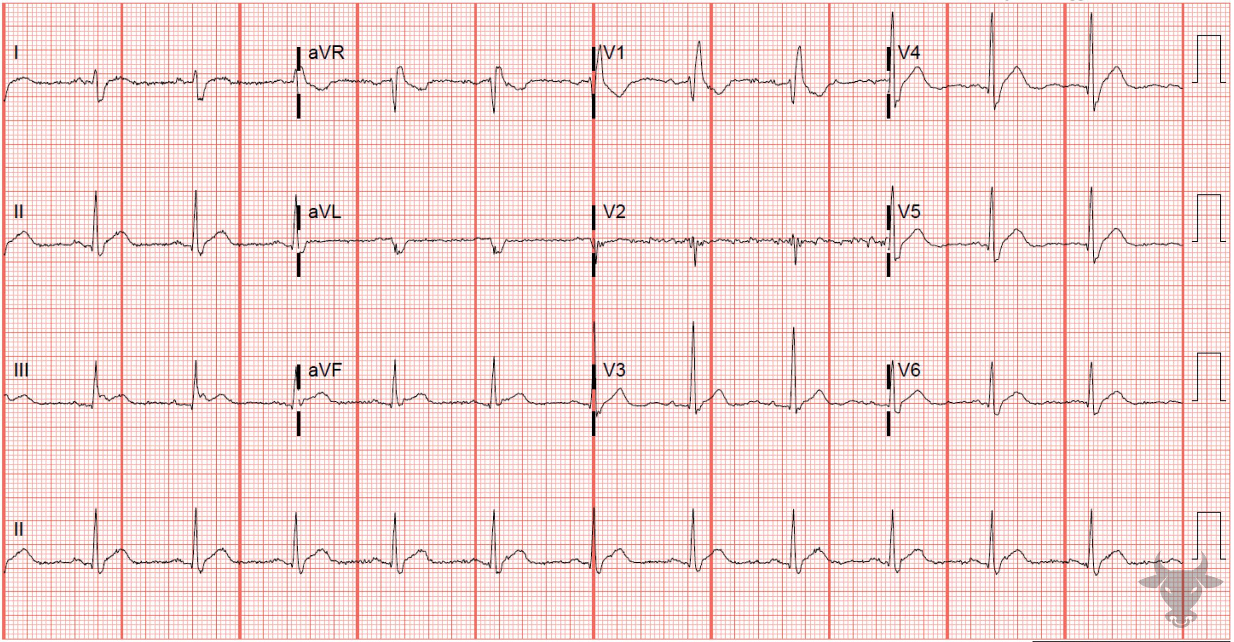 ECG Showing Hypercalcemia
