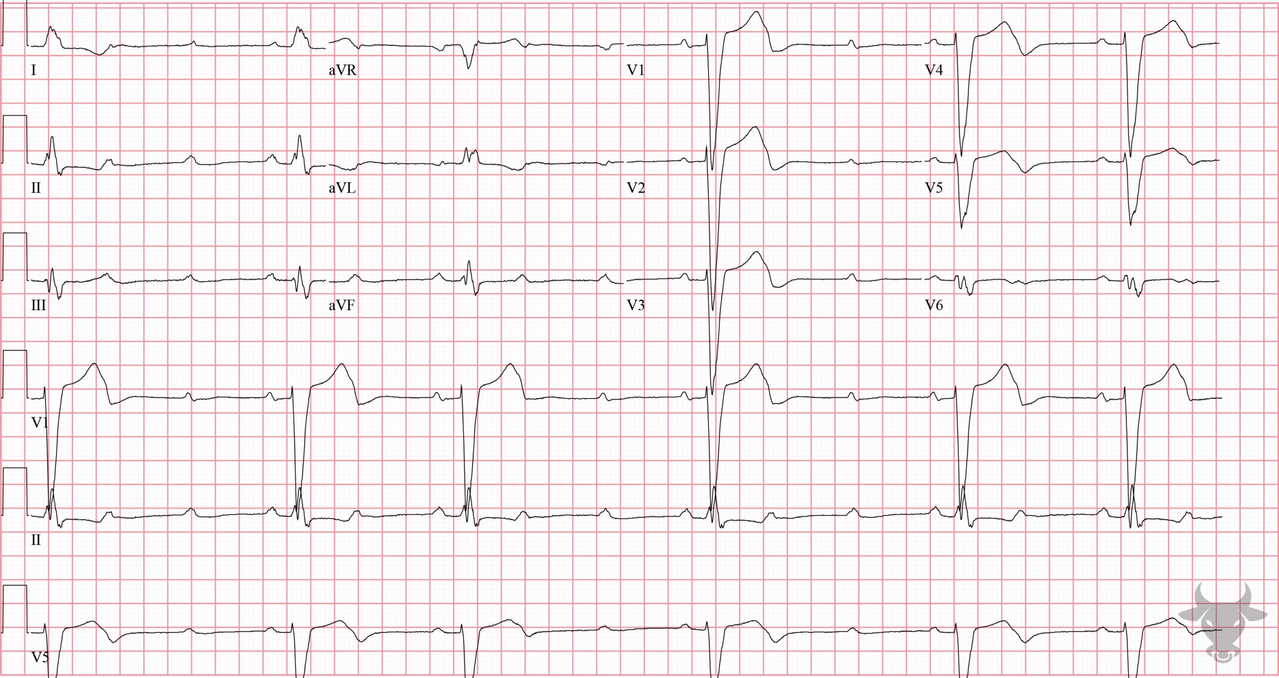 ECG Showing Second Degree Atrioventricular Block - Mobitz II