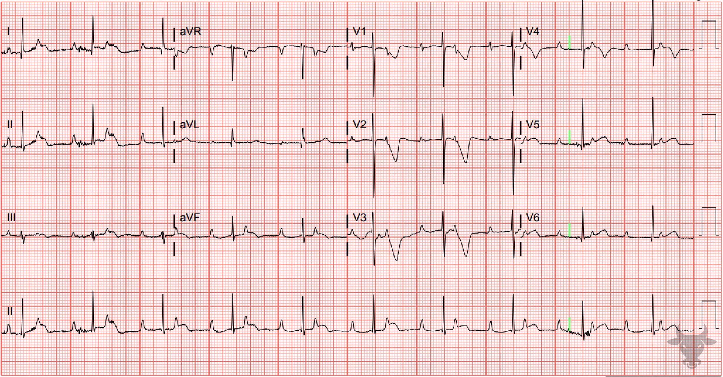 ECG Showing Third Degree Atrioventricular Block