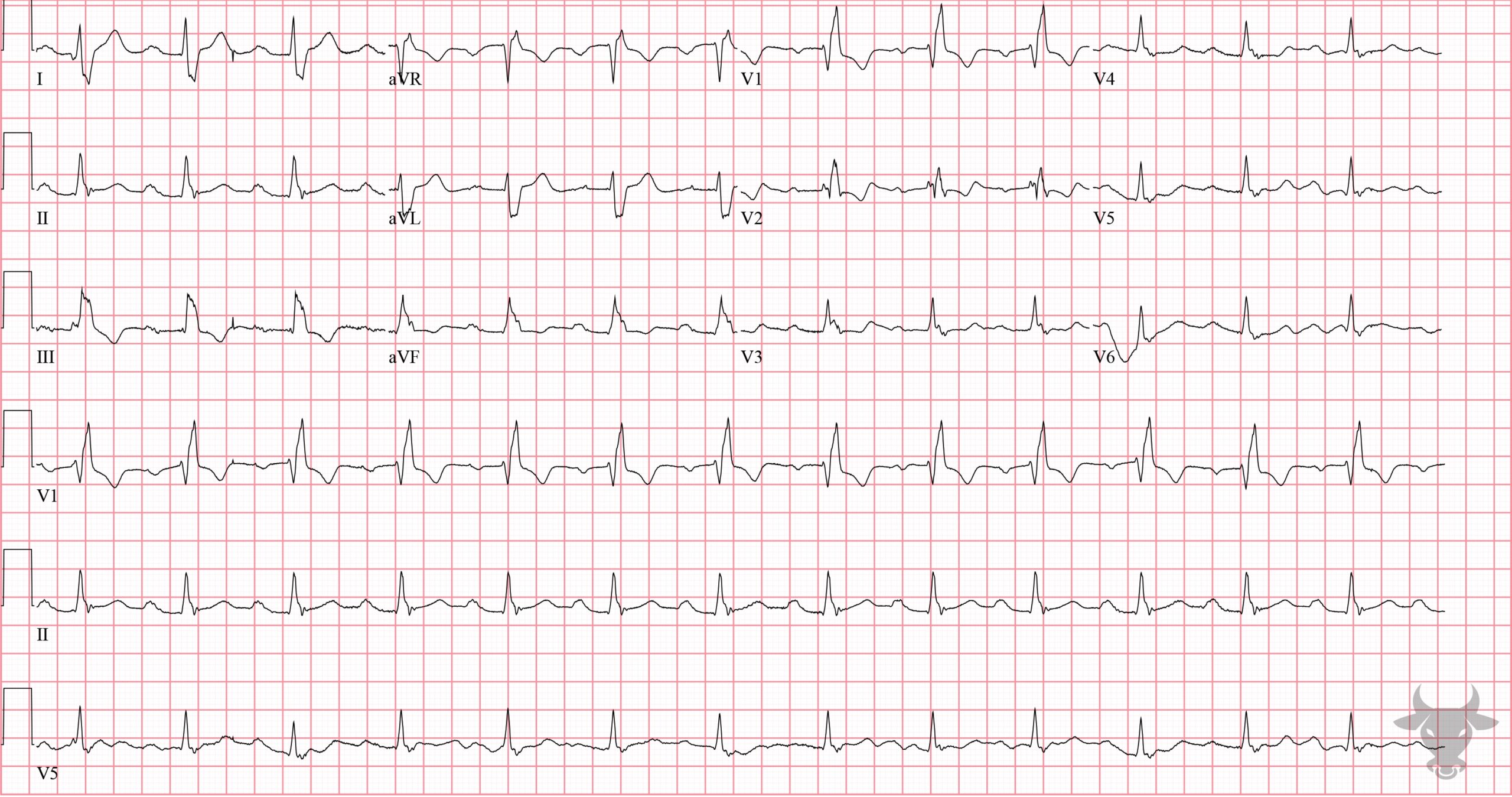 ECG Showing First Degree Atrioventricular Block