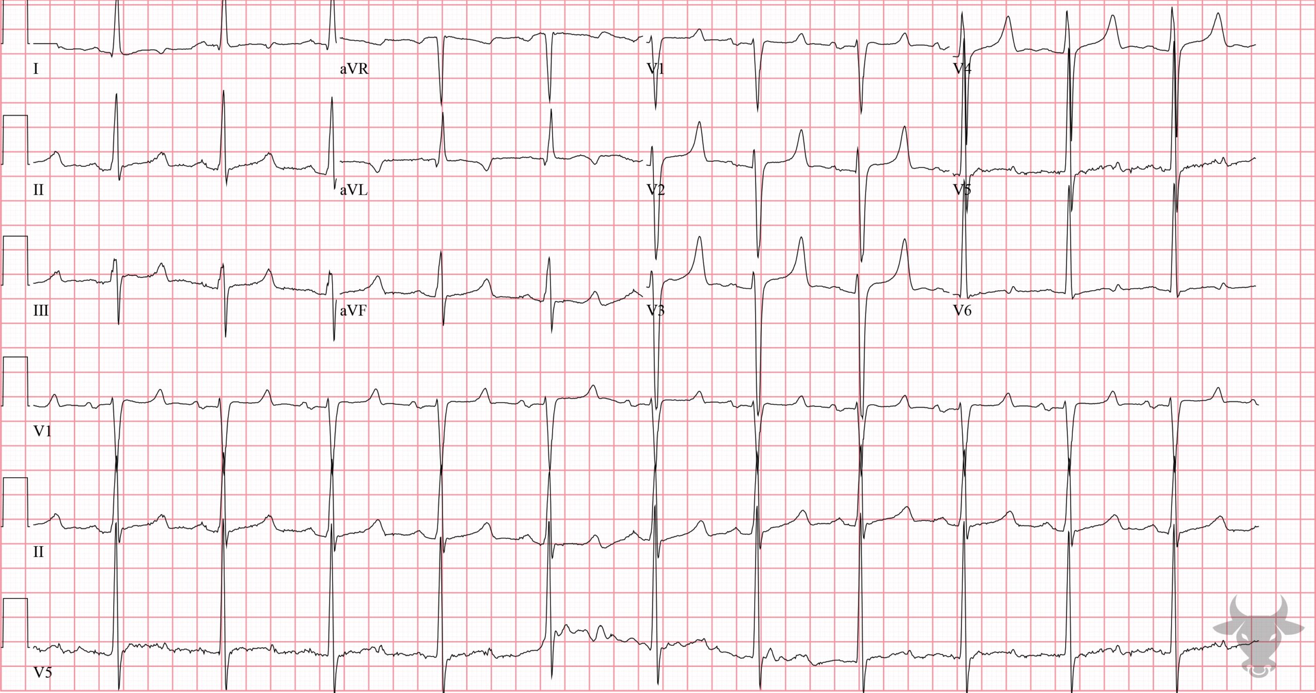 ECG Showing Hypocalcemia