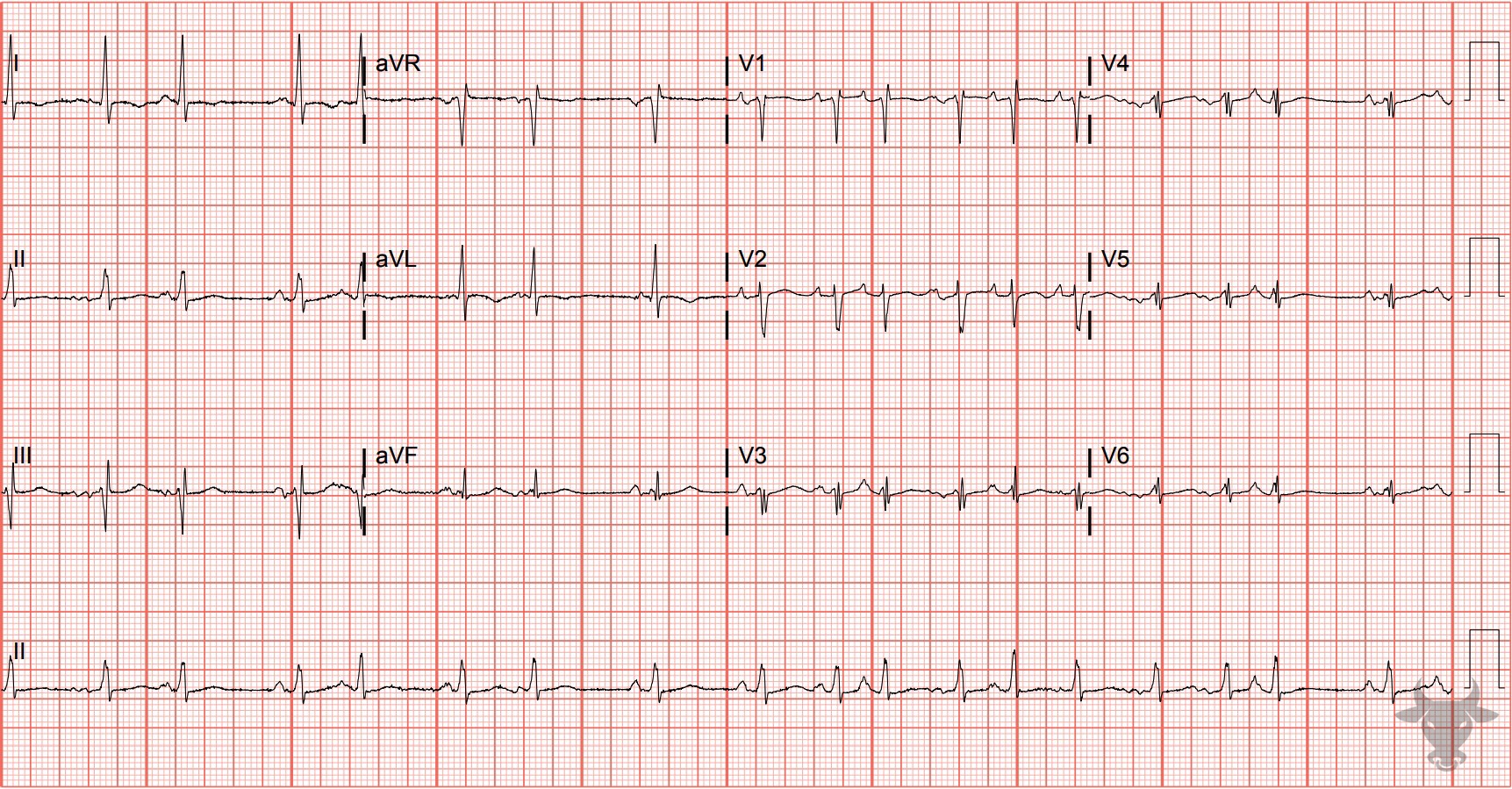 ECG Showing Multifocal Atrial Tachycardia