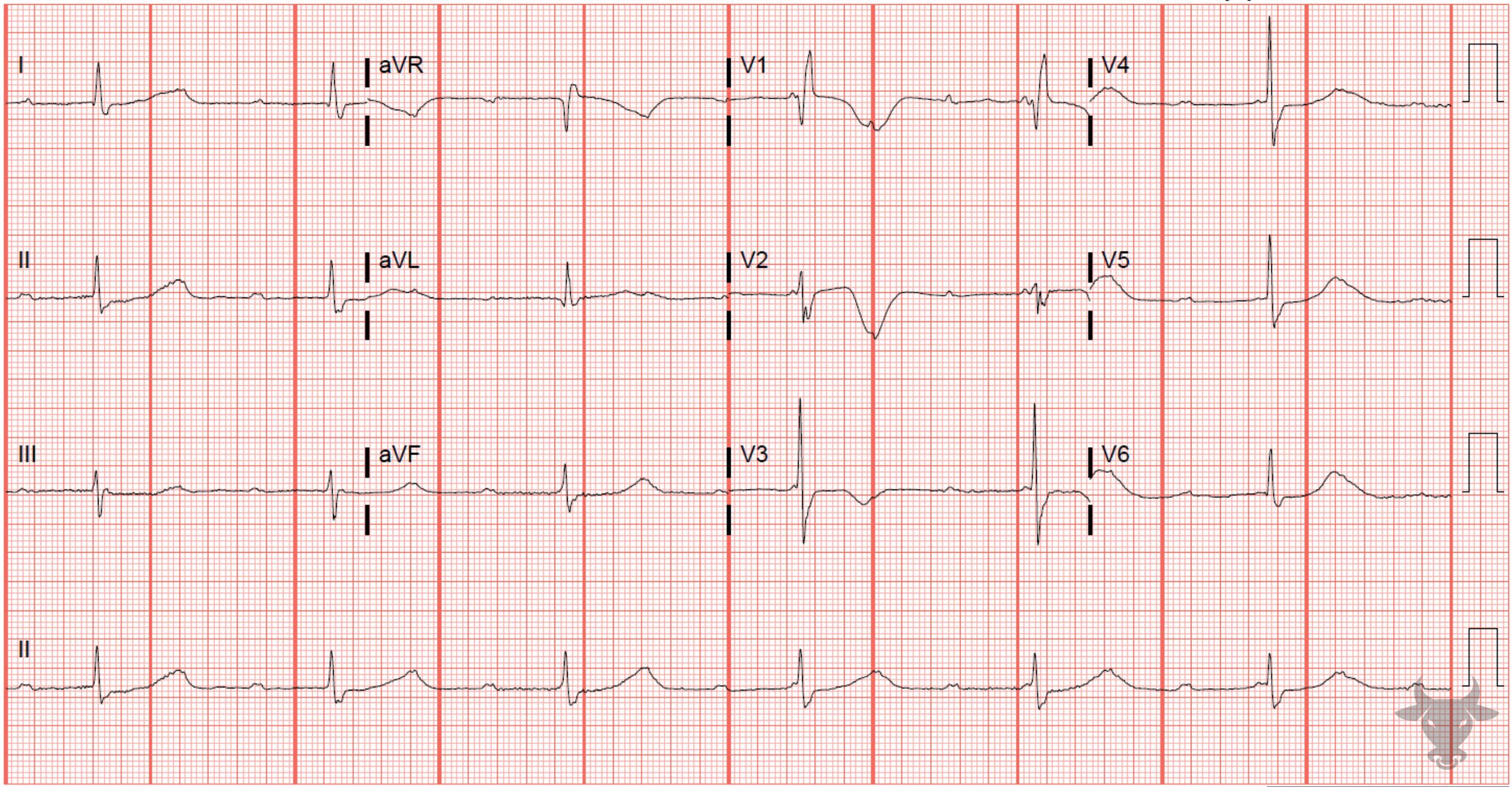ECG Showing Third Degree Atrioventricular Block