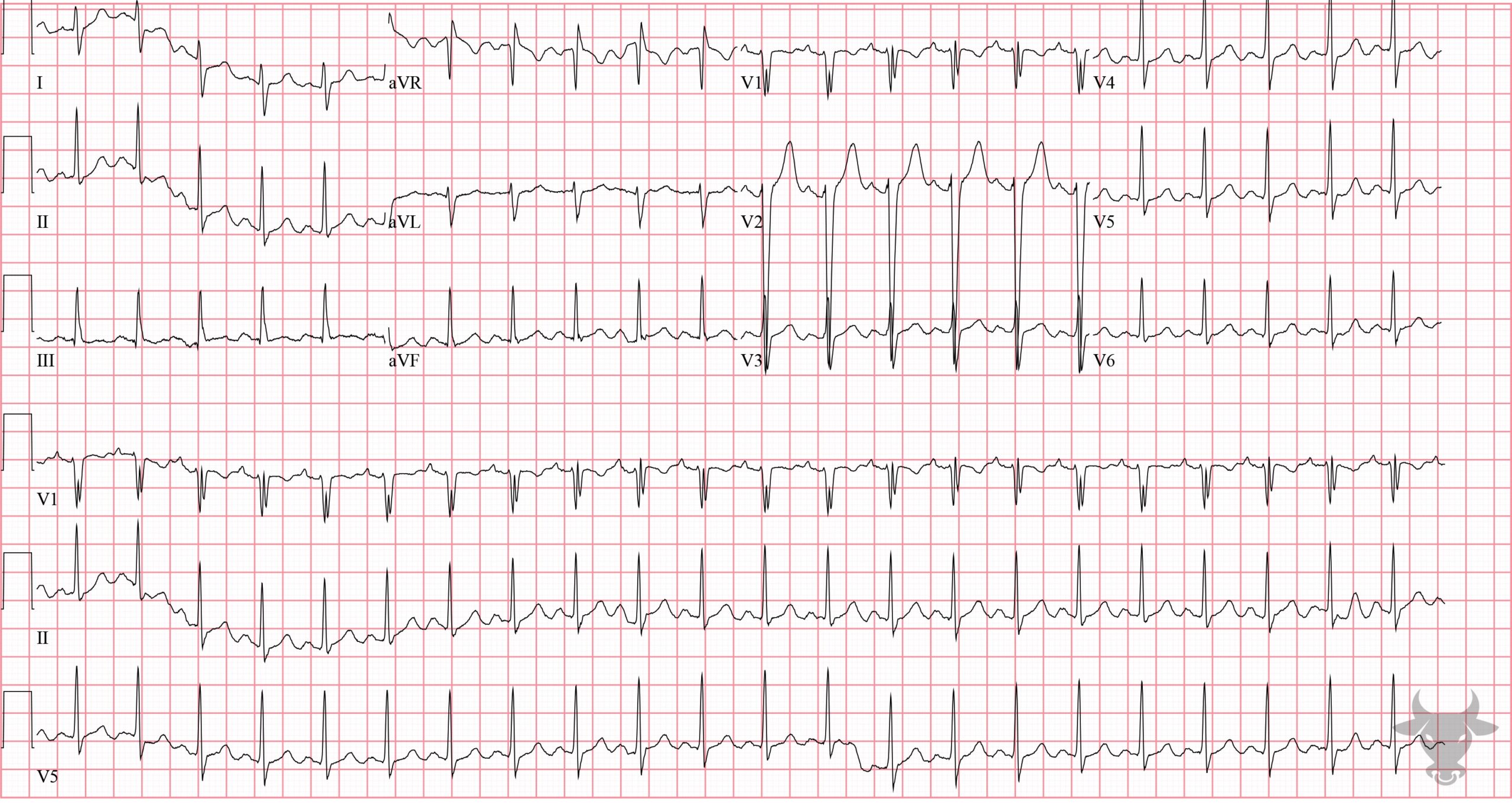 ECG Showing Sodium Channel Toxicity