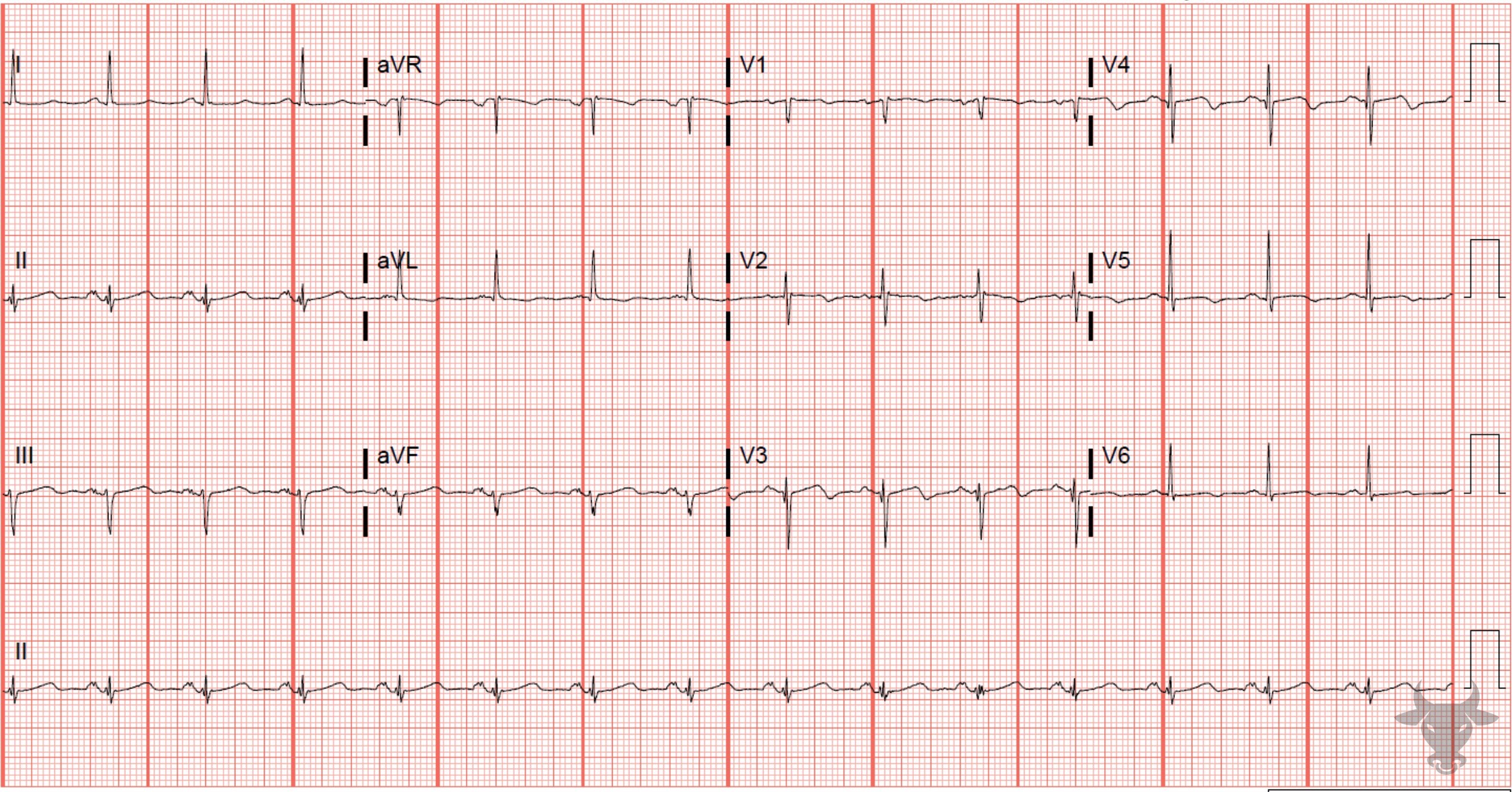 ECG Showing Wellens Syndrome