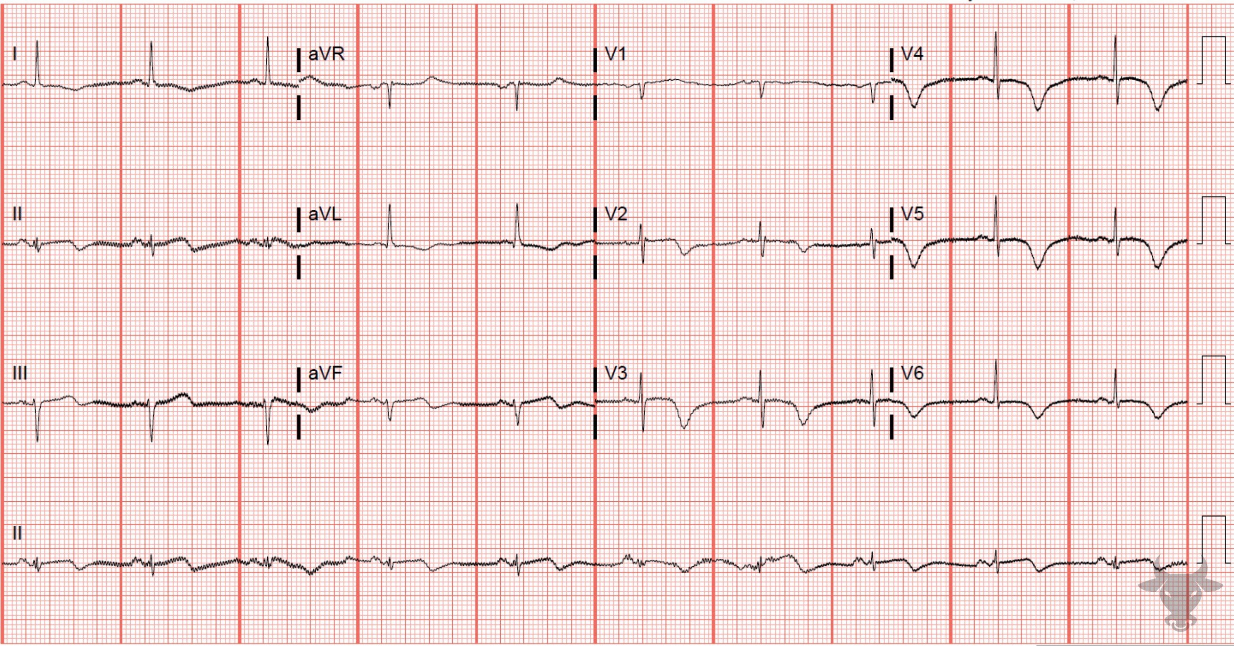 ECG Showing Wellens Syndrome