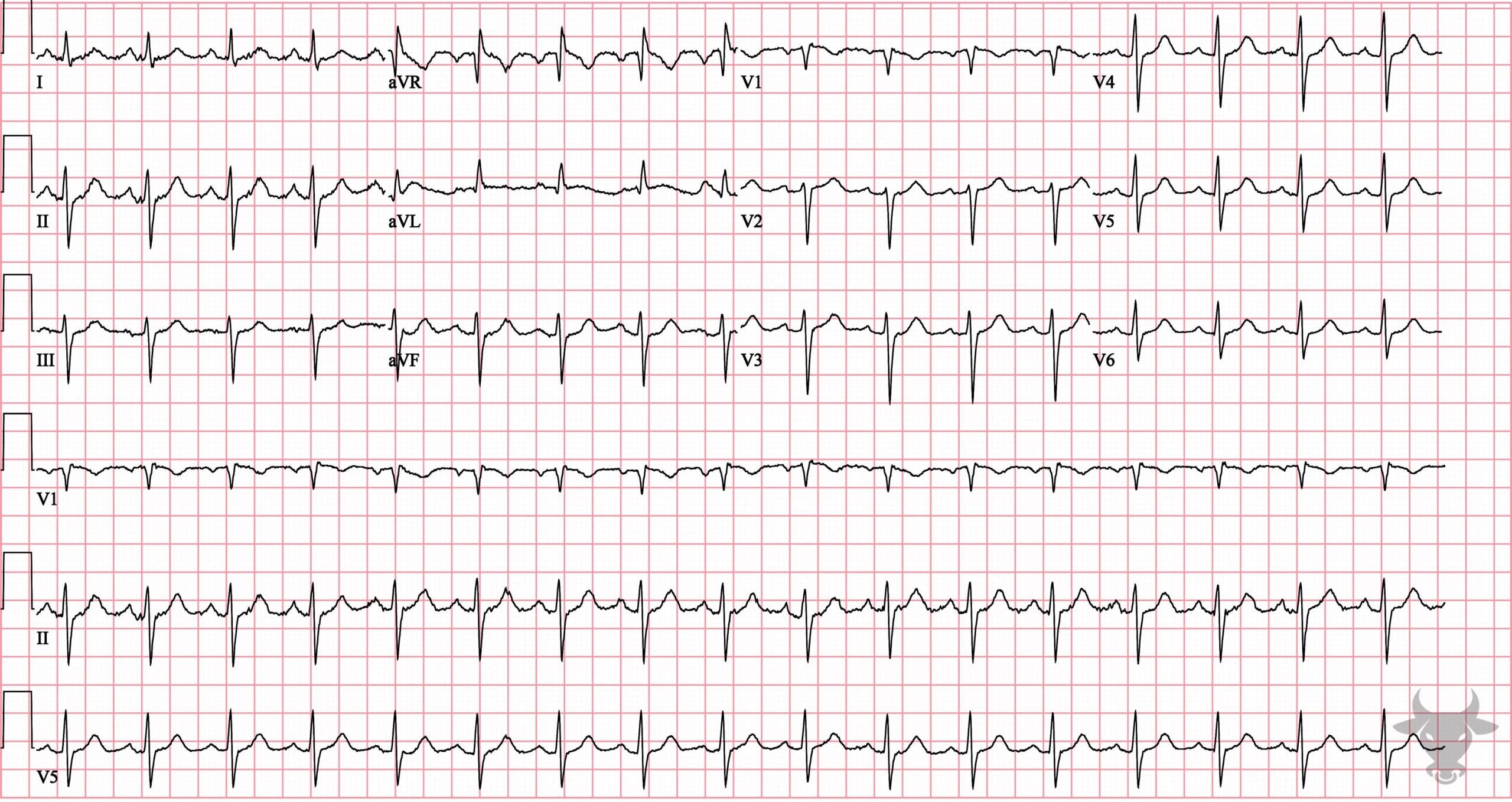 ECG Showing Left Anterior Fascicular Block