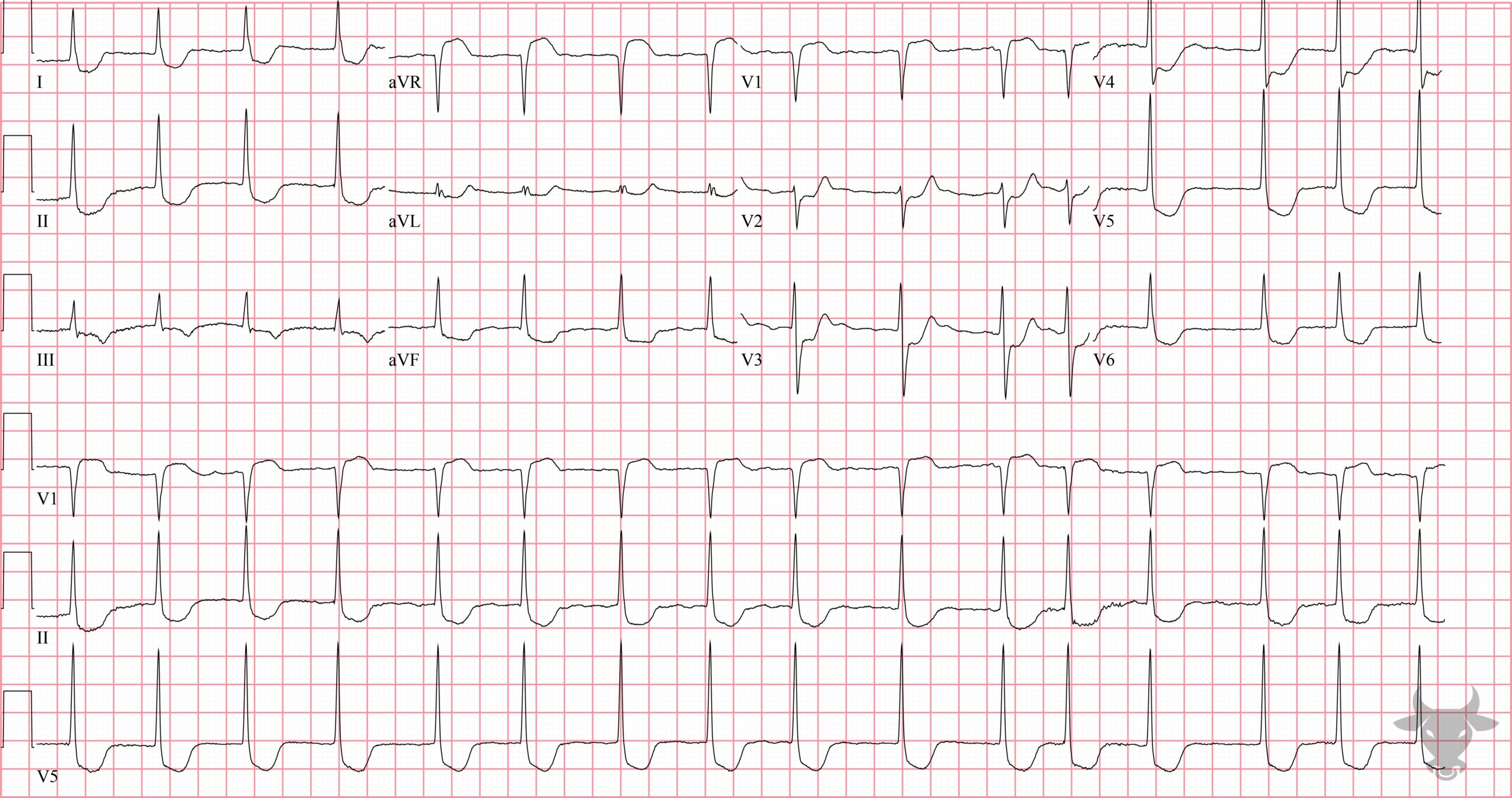 ECG Showing Atrial Flutter