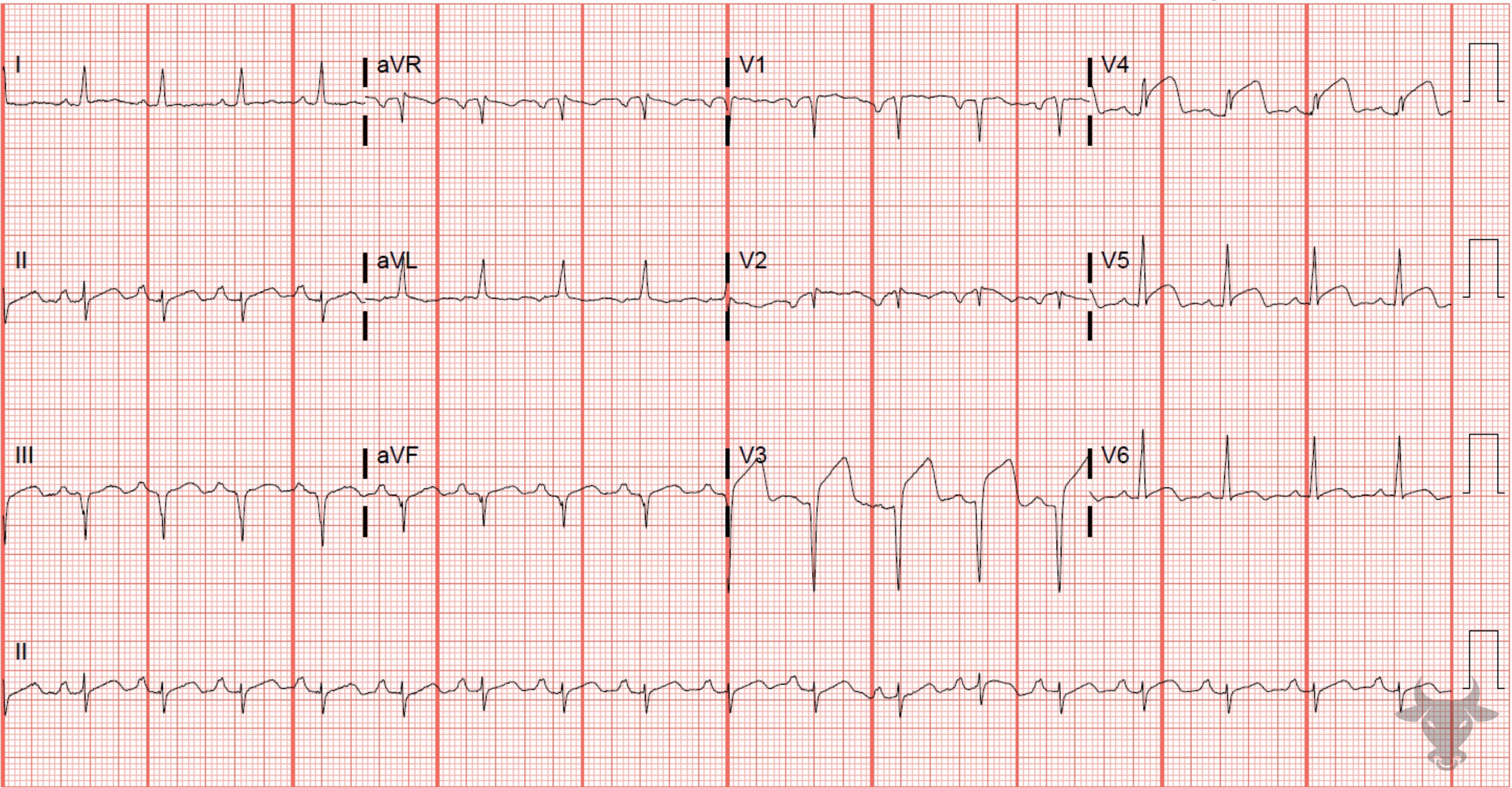 ECG Showing ST-elevation Myocardial Infarction