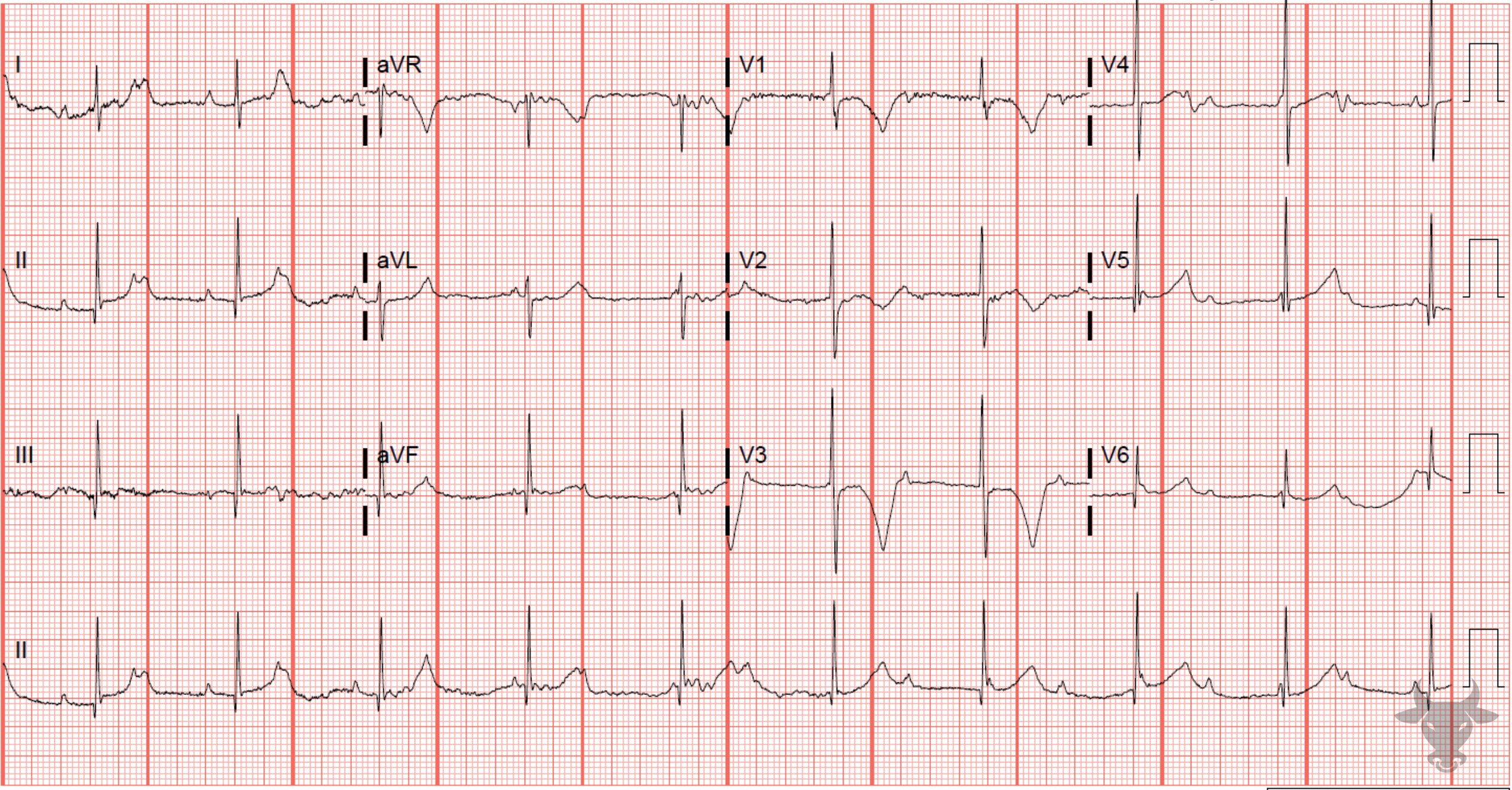 ECG Showing Third Degree Atrioventricular Block