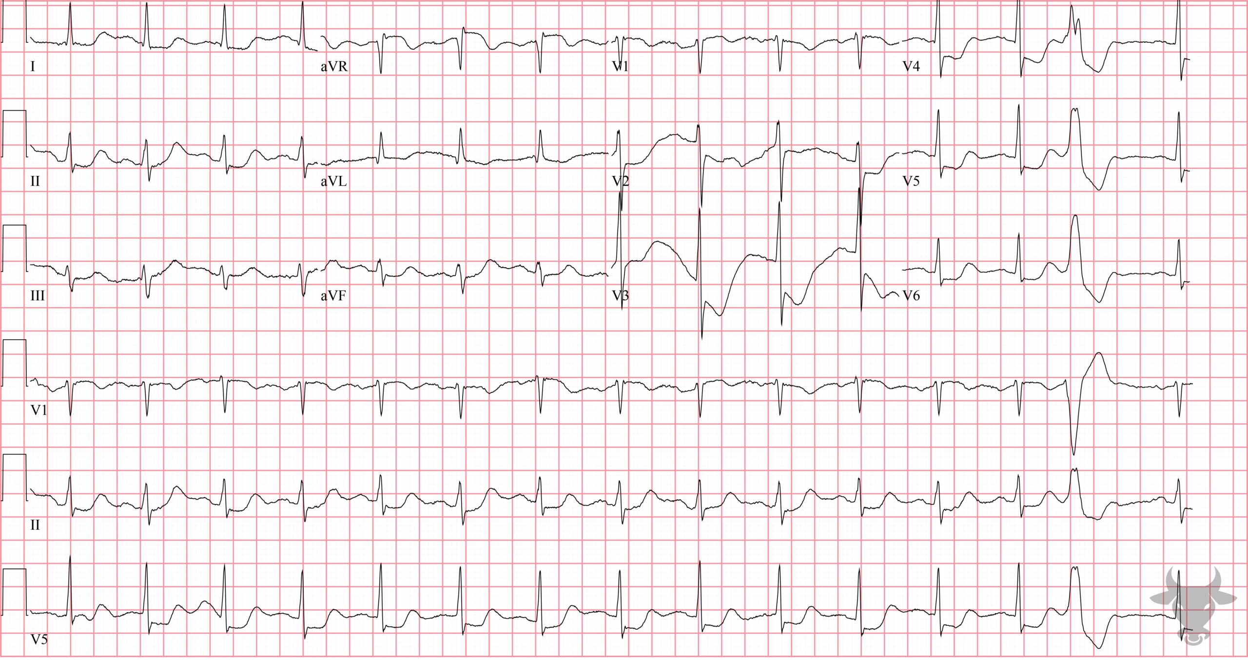 ECG Showing Global Subendocardial Ischemia