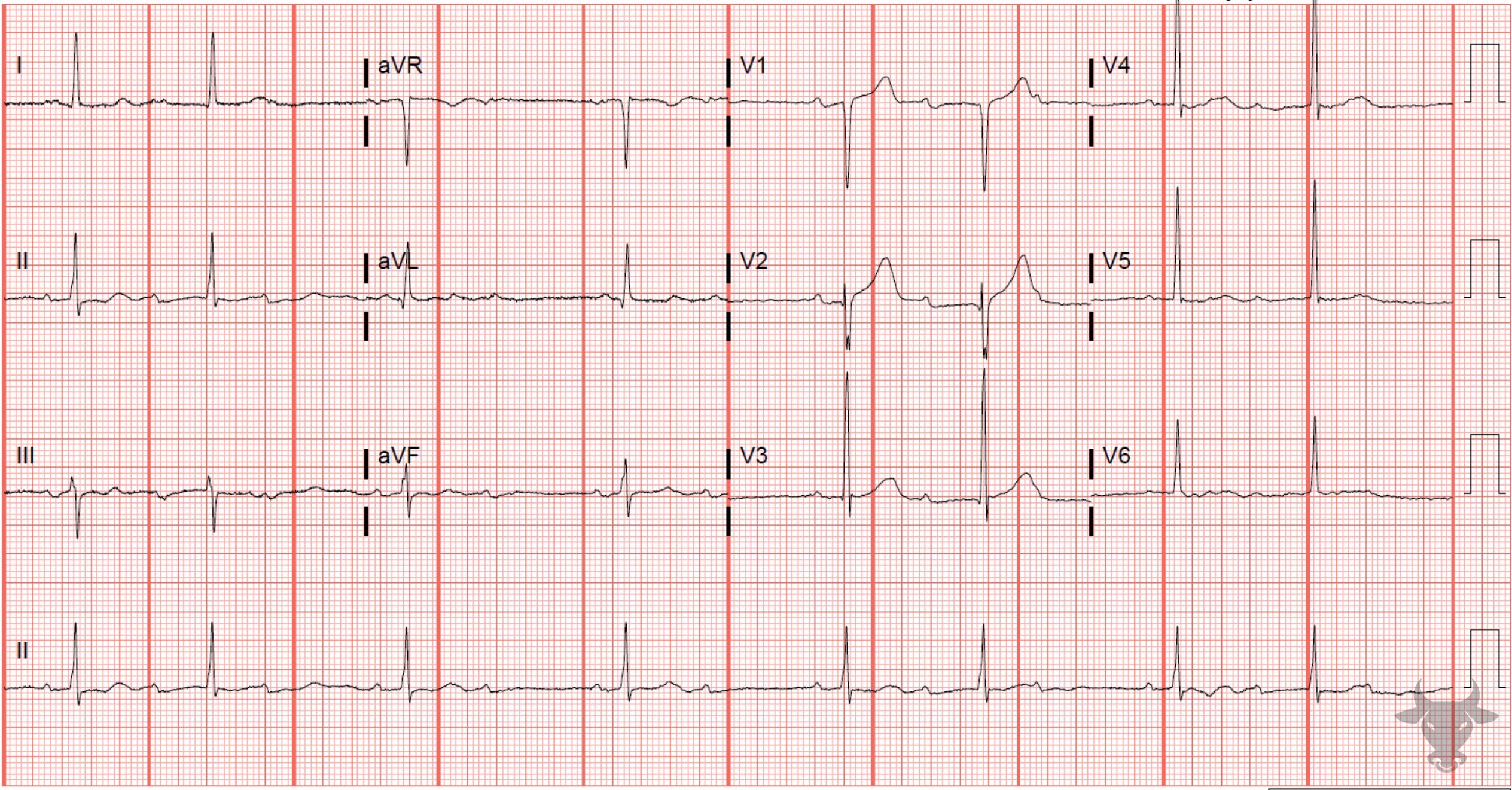 ECG Showing Second Degree Atrioventricular Block - Mobitz I
