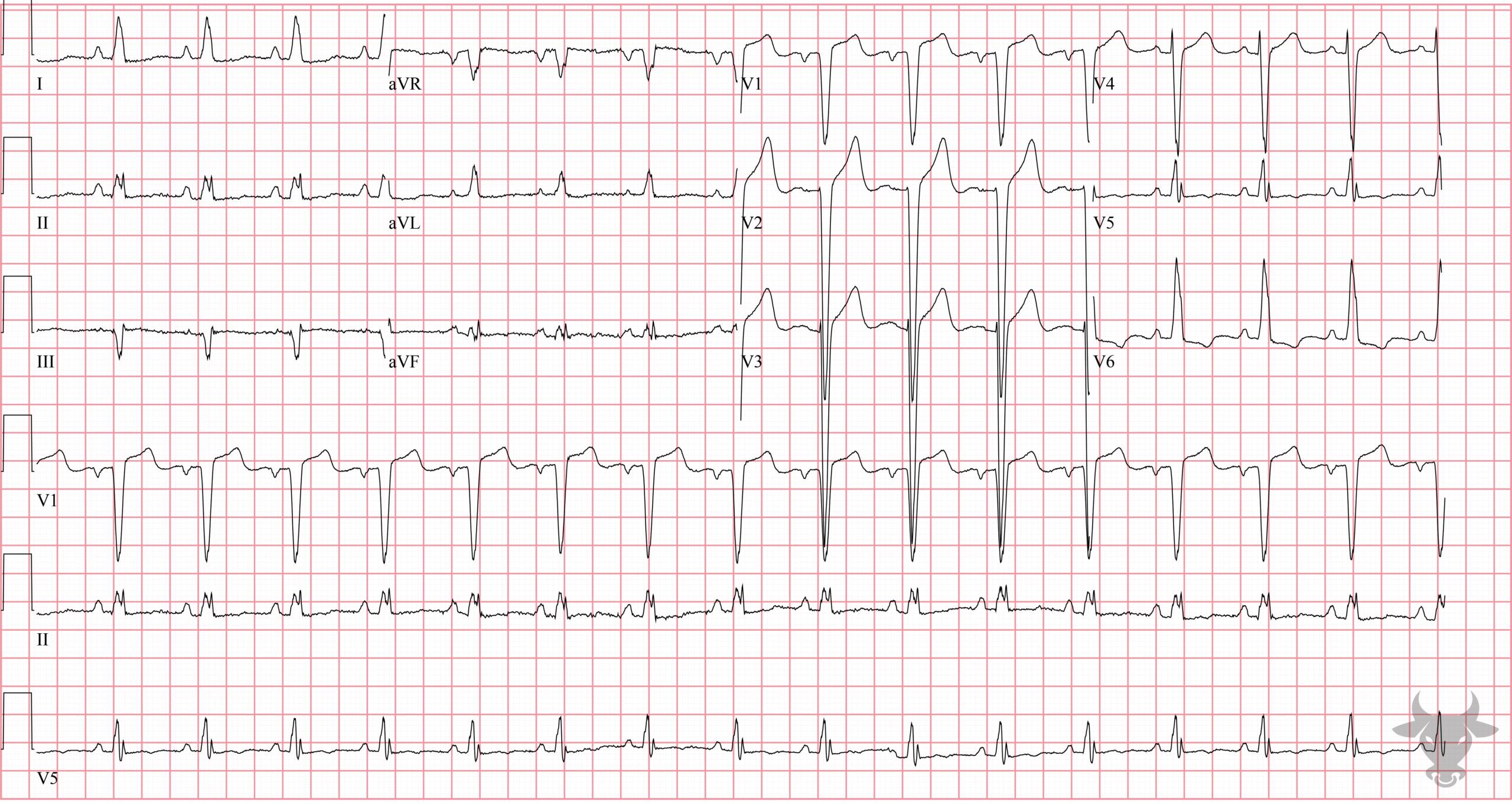 ECG Showing Left Ventricular Hypertrophy
