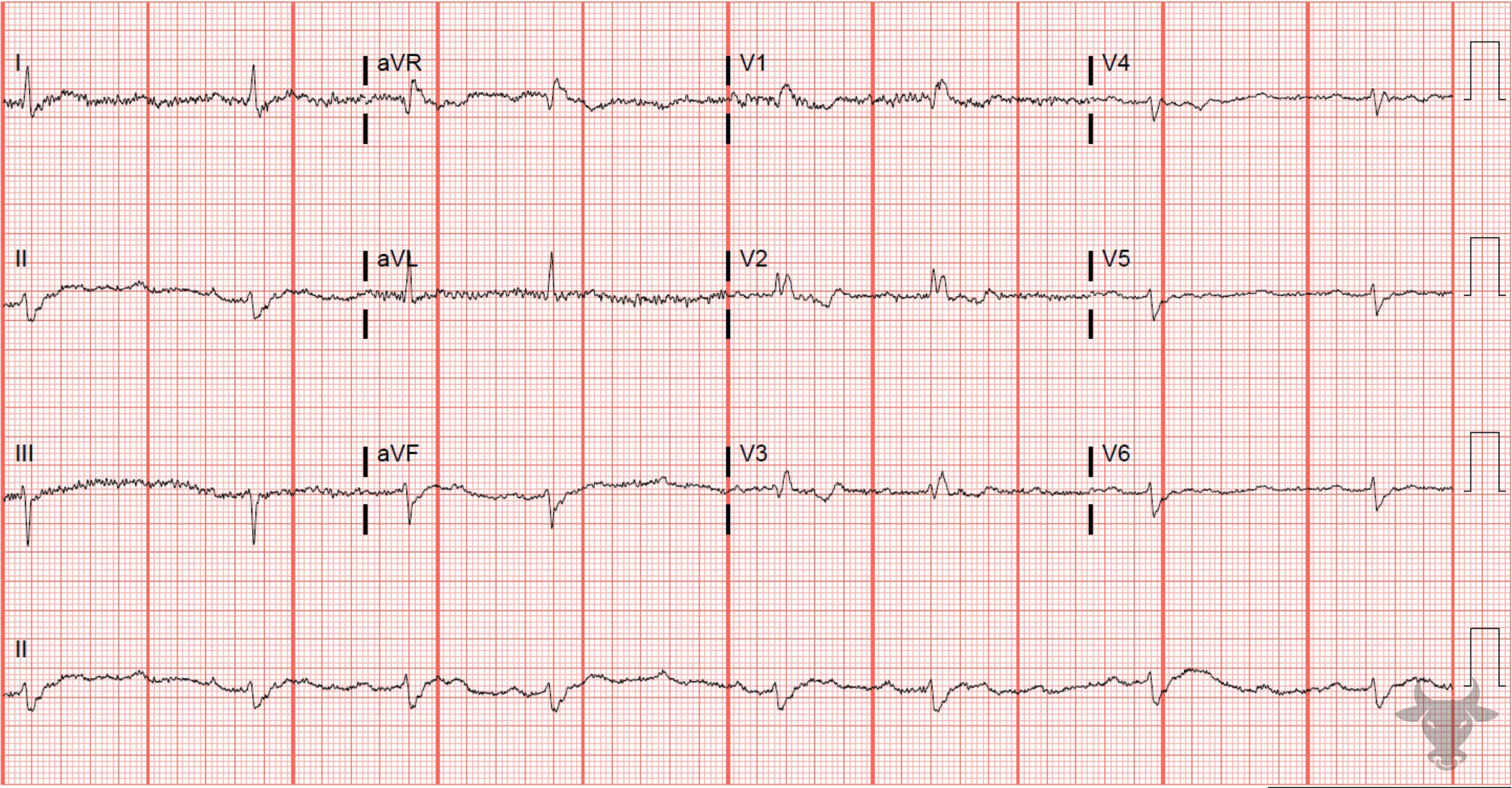 ECG Showing Second Degree Atrioventricular Block - Mobitz II