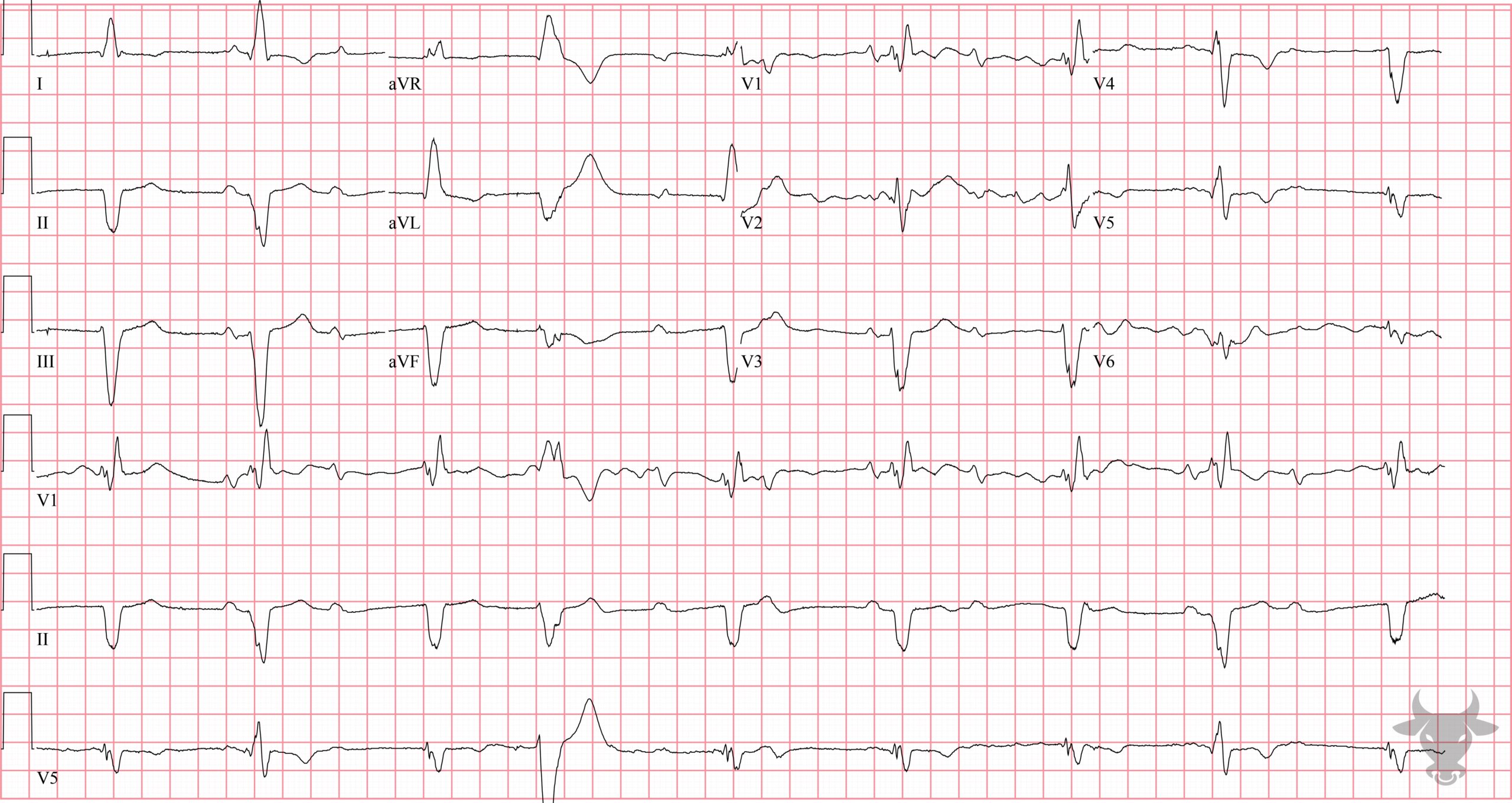 ECG Showing Second Degree Atrioventricular Block