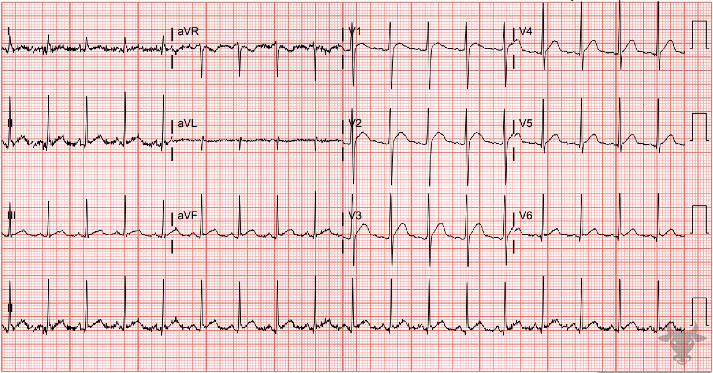 ECG Showing Hypercalcemia