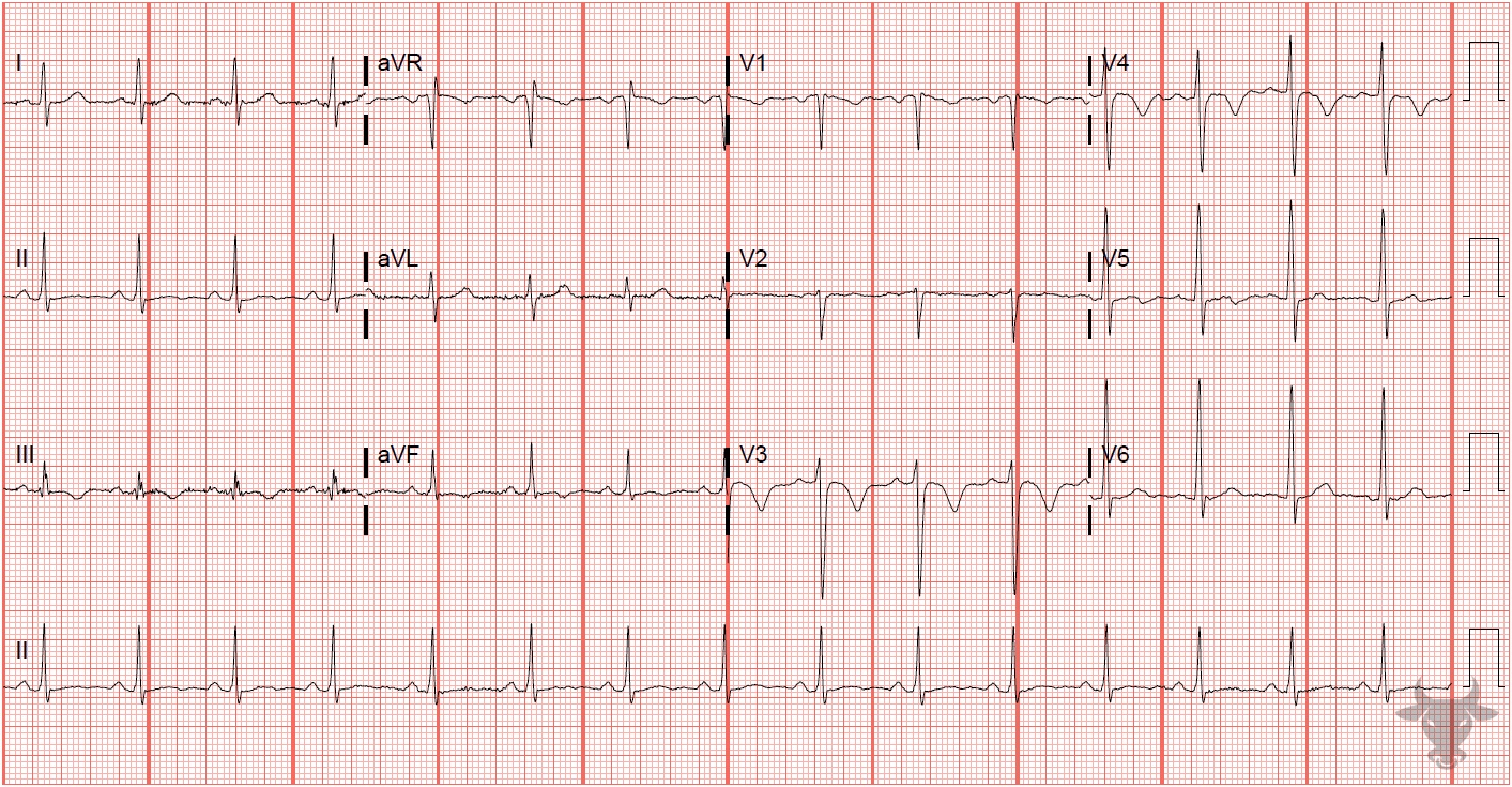 ECG Showing Pulmonary Embolism