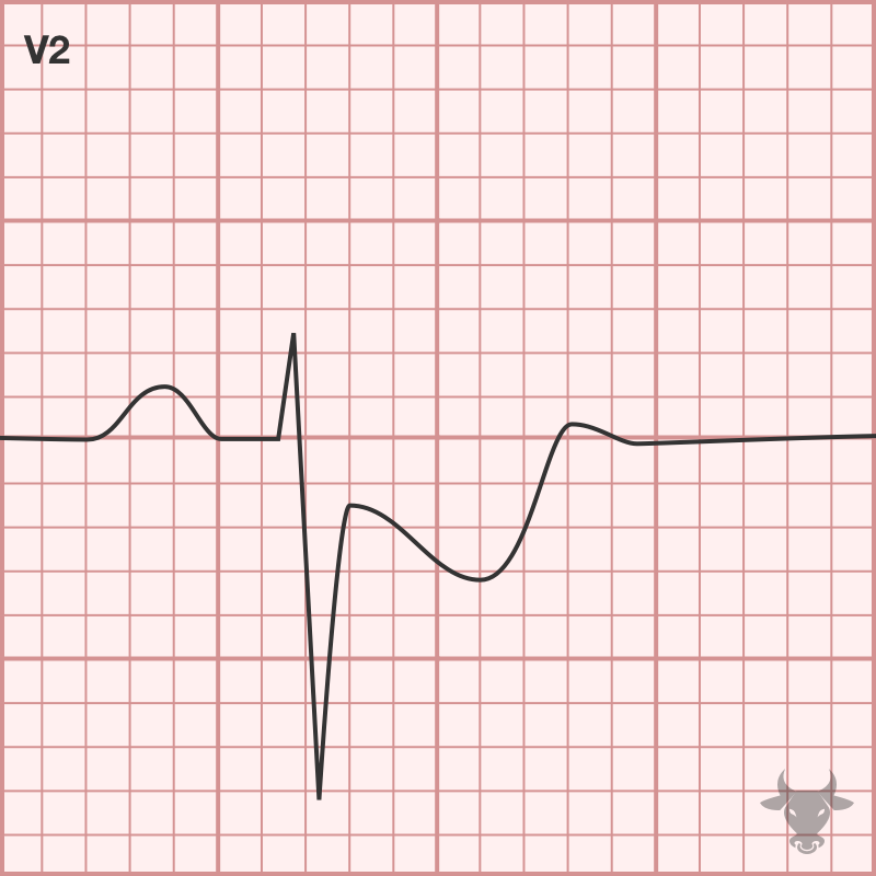 Posterior Myocardial Infarction