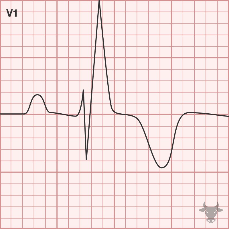 Right Bundle Branch Block