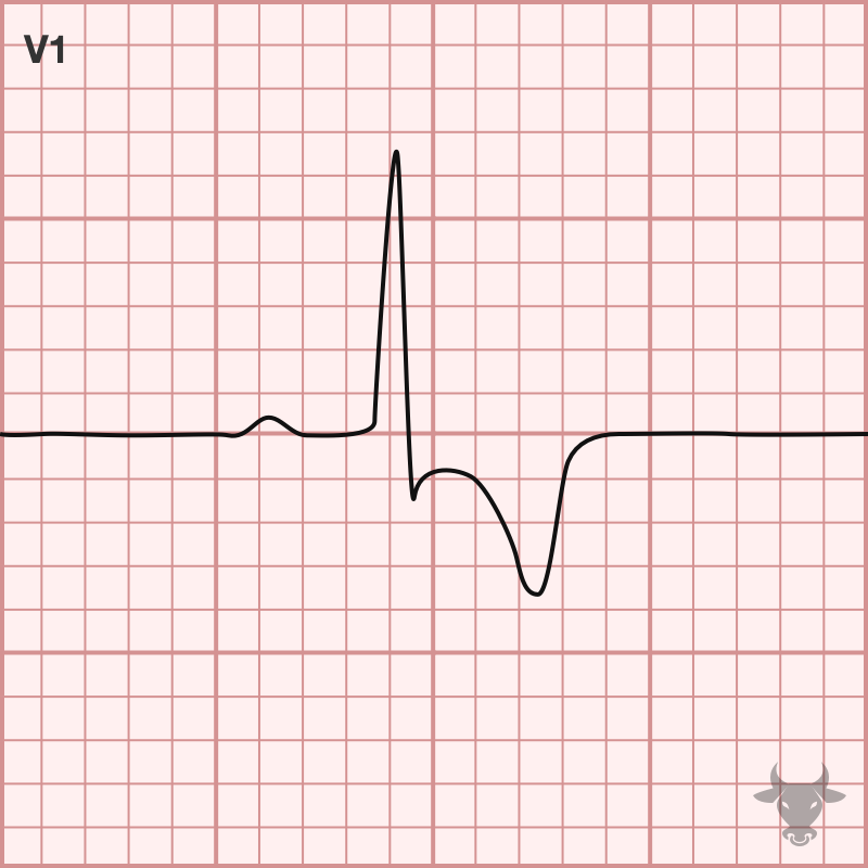 Right Heart Strain