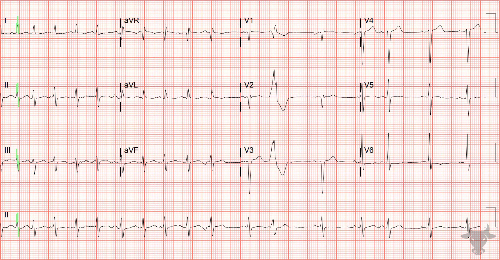 ECG Showing Multifocal Atrial Tachycardia