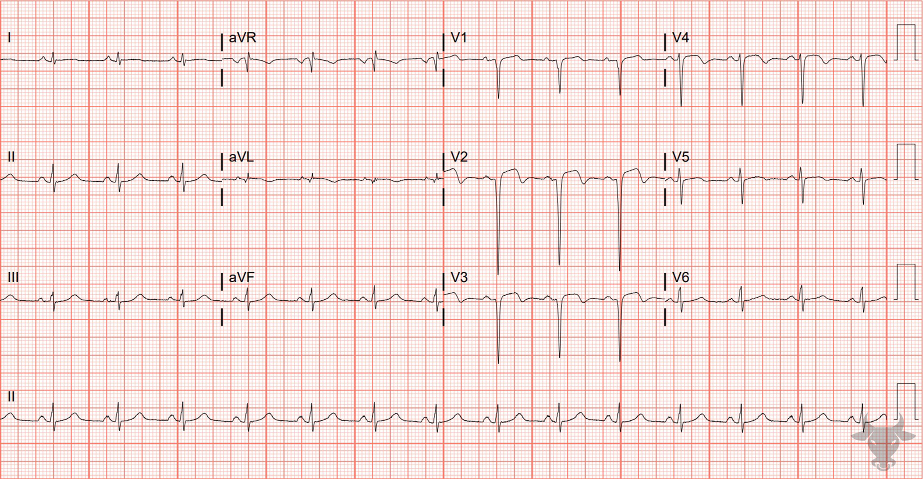 ECG Showing Left Ventricular Aneurysm