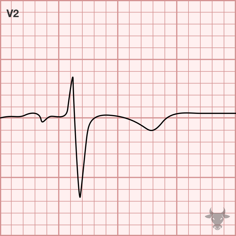 Persistent Juvenile T Wave Pattern