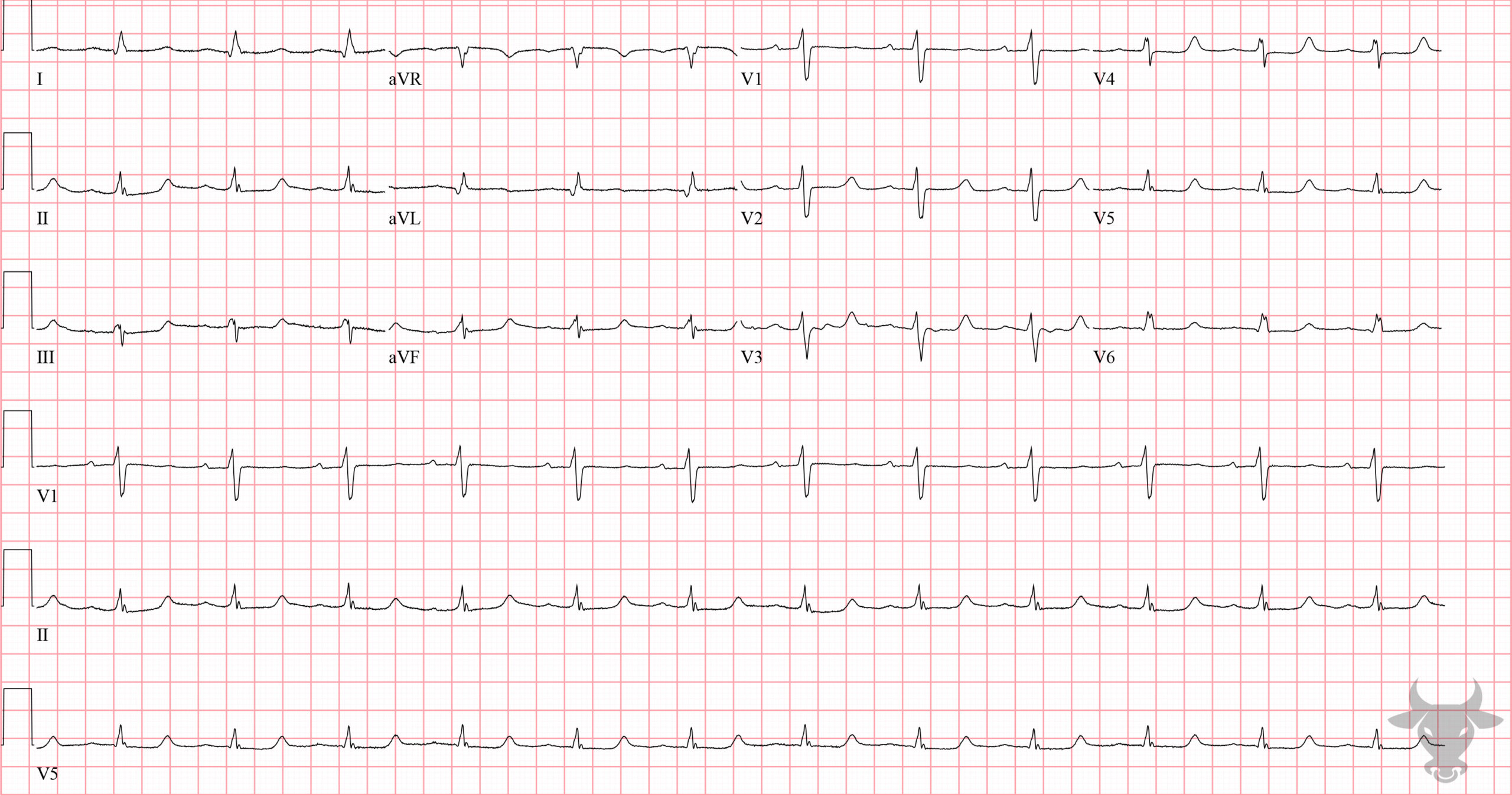 ECG Showing Hypocalcemia